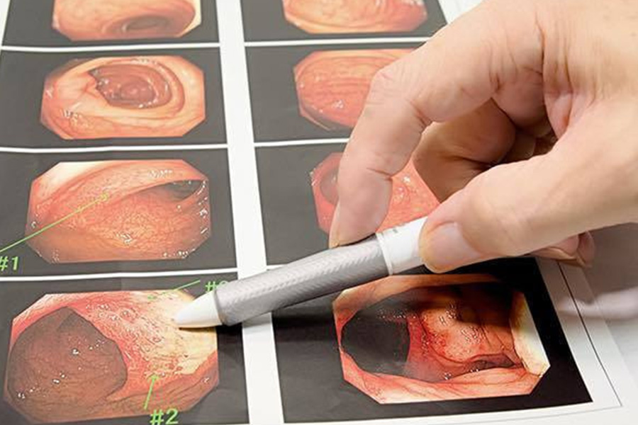 大腸内視鏡検査